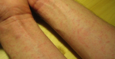 allergie e intolleranze alimentari